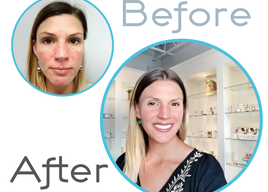 Annie’s Skin Care Battle: Skin Care Solution for Rosacea